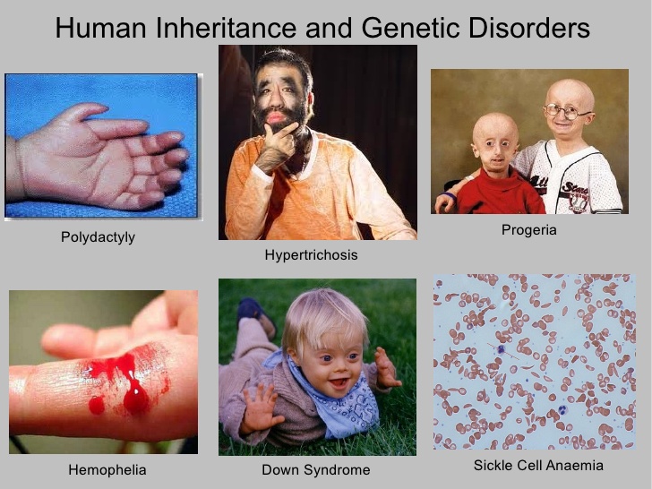 Geneticsbirth Defects As Related To Rare Diseases Pictures
